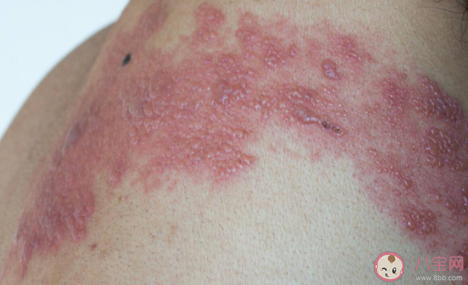 帶狀皰疹能自愈為什么要預(yù)防 帶狀皰疹疫苗為什么50歲以上才能接種