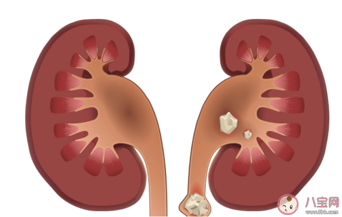 泌尿結(jié)石為什么容易夏天發(fā)生 哪些生活習慣更容易導(dǎo)致尿結(jié)石 泌尿結(jié)石為什么容易夏天發(fā)生 哪些生活習慣更容易導(dǎo)致尿結(jié)石