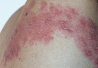 帶狀皰疹能自愈為什么要預(yù)防 帶狀皰疹疫苗為什么50歲以上才能接種