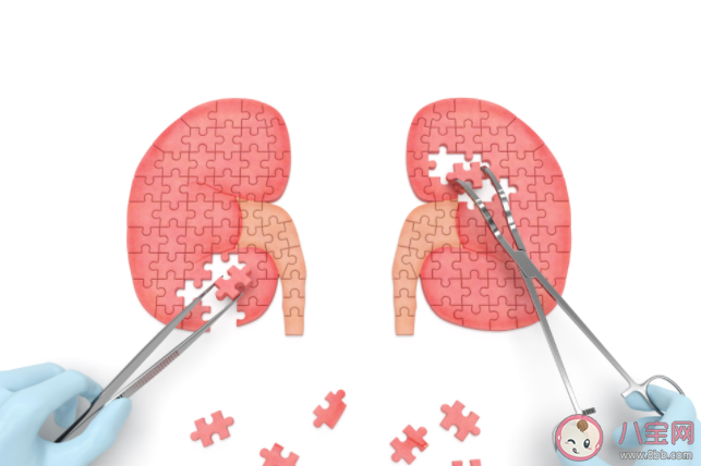 泌尿系統結石有哪些典型癥狀 如何治療泌尿系統結石
