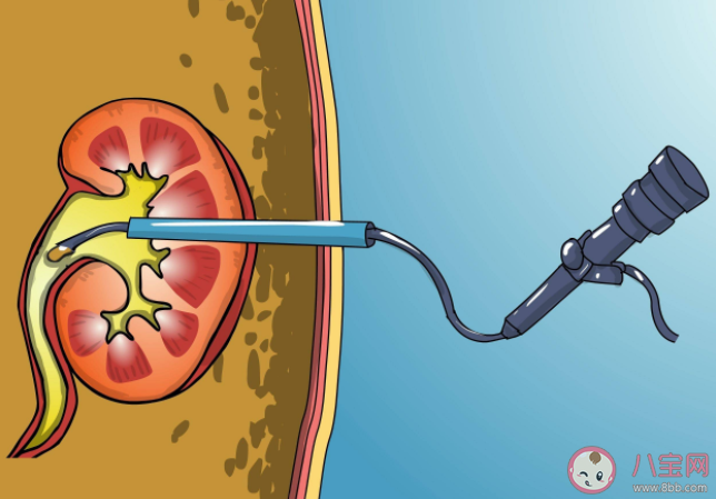 泌尿系統(tǒng)結(jié)石哪些人更容易多發(fā) 泌尿系統(tǒng)結(jié)石日常護理要注意什么 泌尿系統(tǒng)結(jié)石哪些人更容易多發(fā) 泌尿系統(tǒng)結(jié)石日常護理要注意什么