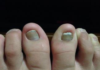 灰指甲可以不治嗎 灰指甲拔了才能徹底治好嗎