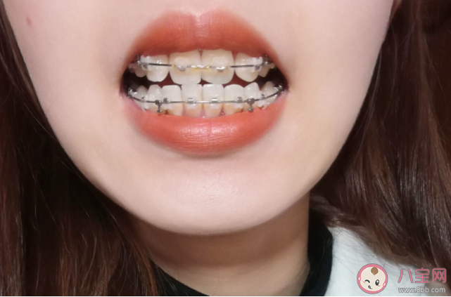 成年人矯正牙齒更容易反彈嗎 矯正牙齒有年齡限制嗎