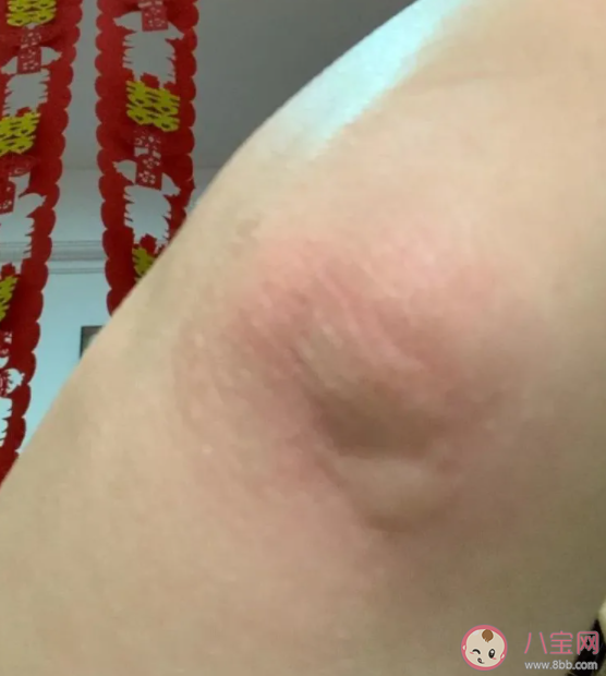 蚊子包越大毒性越大嗎 被蚊子咬起大包怎么辦