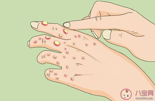 猴痘病毒可通過飛沫傳播嗎 猴痘病毒來源是什么 猴痘病毒可通過飛沫傳播嗎 猴痘病毒來源是什么