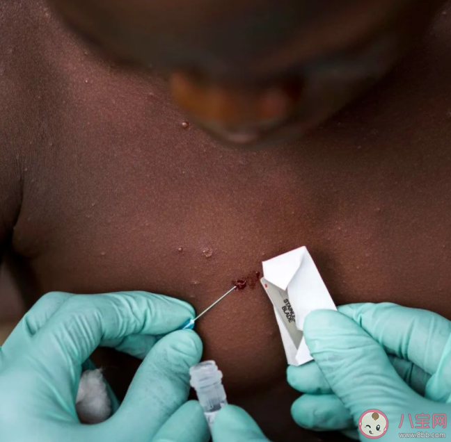 猴痘病毒可通過飛沫傳播嗎 猴痘病毒來源是什么 猴痘病毒可通過飛沫傳播嗎 猴痘病毒來源是什么