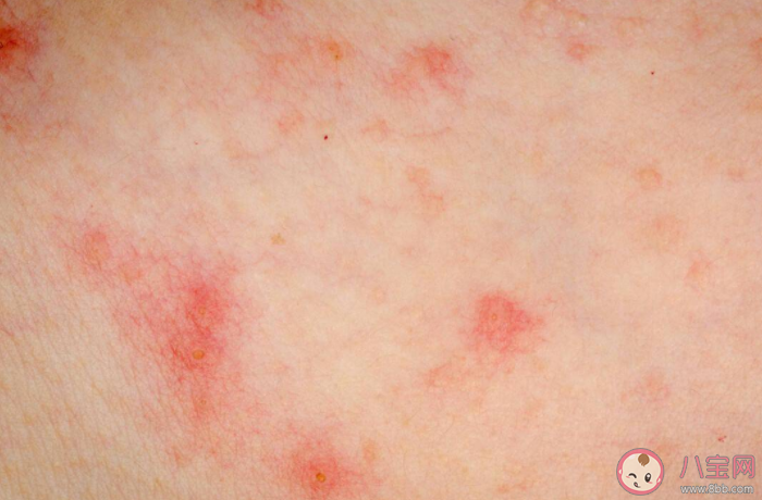 涂花椒水可治過敏性皮炎嗎 如何預防過敏性皮炎 涂花椒水可治過敏性皮炎嗎 如何預防過敏性皮炎