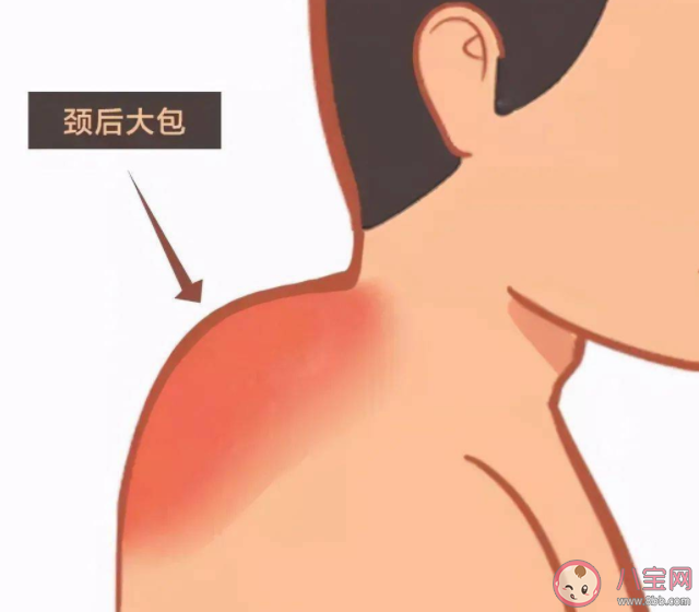 如何判斷自己是否有富貴包 富貴包康復訓練怎么做