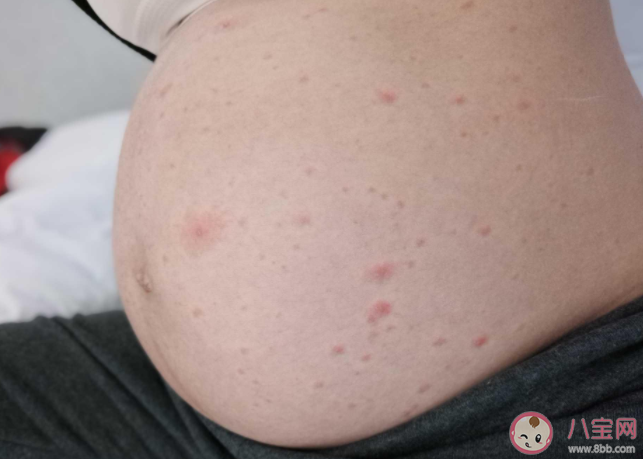 孕期長水痘對胎兒有什么影響 孕期水痘怎么處理