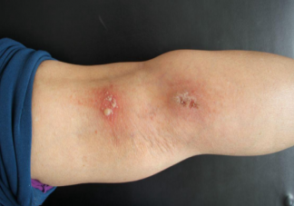 隱翅蟲毒液堪比硫酸 隱翅蟲咬人致命嗎