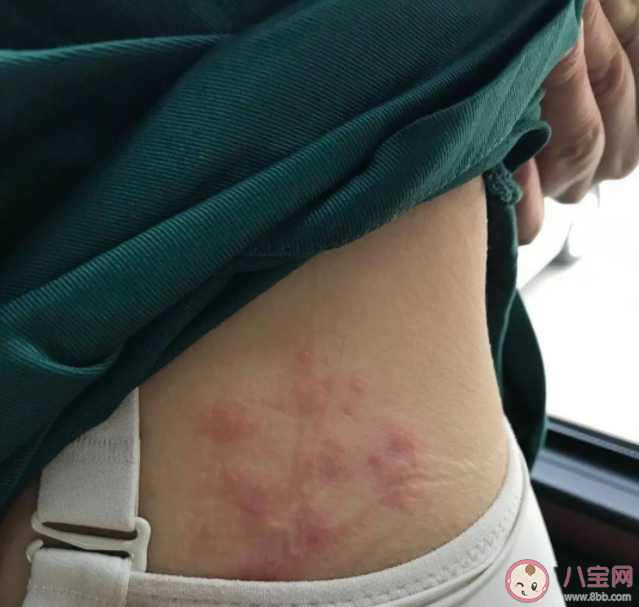 帶狀皰疹長滿一圈會死人嗎 帶狀皰疹會致命嗎