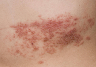 哪些人易感染帶狀皰疹 如何日常生活中預防帶狀皰疹