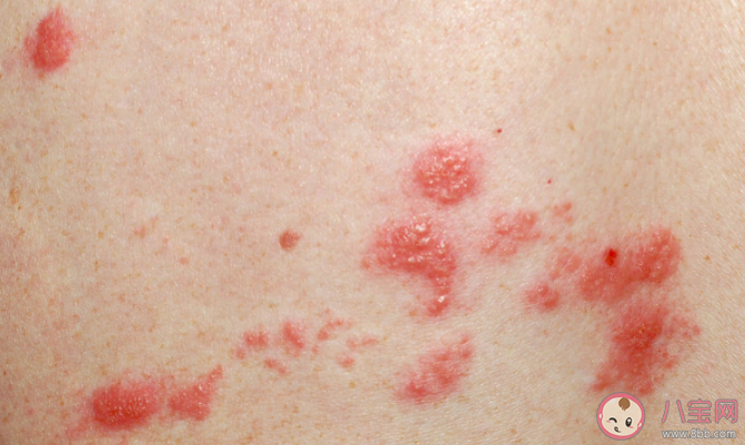 帶狀皰疹疫苗到底有沒(méi)有必要打 帶狀皰疹疫苗為什么那么貴 帶狀皰疹疫苗到底有沒(méi)有必要打 帶狀皰疹疫苗為什么那么貴