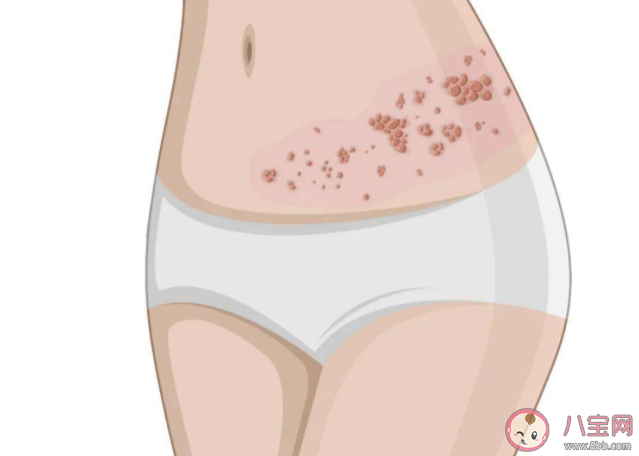 帶狀皰疹疫苗到底有沒(méi)有必要打 帶狀皰疹疫苗為什么那么貴 帶狀皰疹疫苗到底有沒(méi)有必要打 帶狀皰疹疫苗為什么那么貴