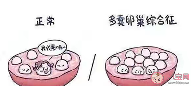 患有多囊卵巢能懷孕嗎 多囊卵巢的癥狀有哪些