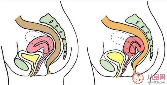 子宮前位更容易懷孕嗎 子宮前位的女性該如何保養(yǎng)身體