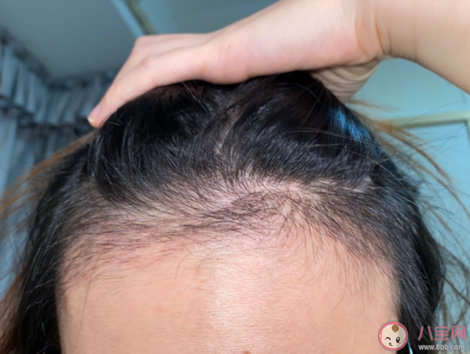 父母禿頭孩子也會(huì)禿頭嗎 為什么男生比女生容易禿