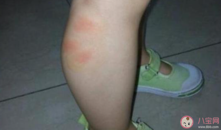 孕婦和寶寶更容易招蚊子真是這樣嗎 螞蟻莊園7月6日答案最新