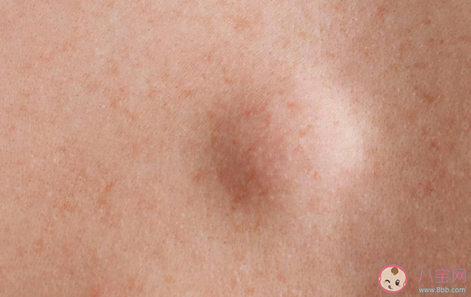 脂肪瘤的癥狀有哪些 為什么會長脂肪瘤