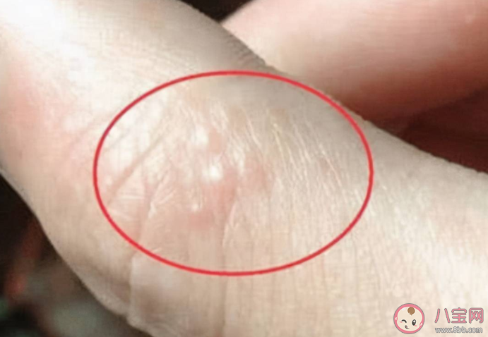 汗皰疹可以掐破嗎 汗皰疹和什么方面有關(guān)