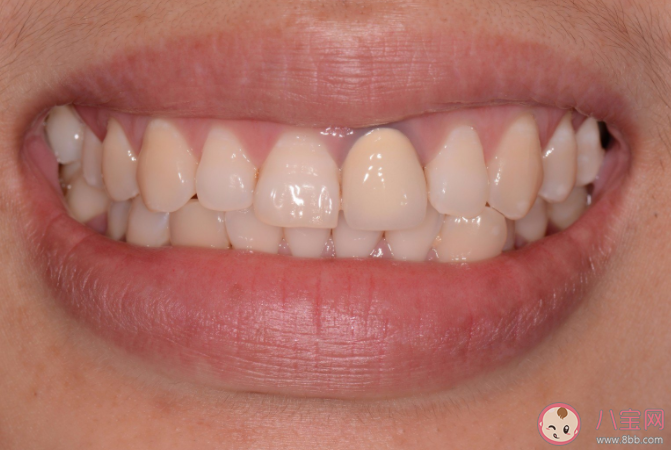 根管治療有多復雜 根管治療要花多少錢 根管治療有多復雜 根管治療要花多少錢