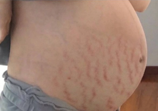 孕期如何改善妊娠紋 外用護膚品能減輕改善妊娠紋嗎