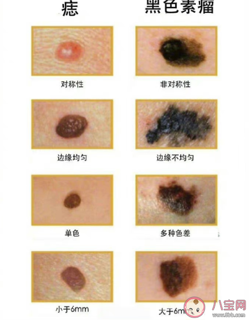 如何區分痣和黑色素瘤 長在什么部位的痣要多當心 如何區分痣和黑色素瘤 長在什么部位的痣要多當心