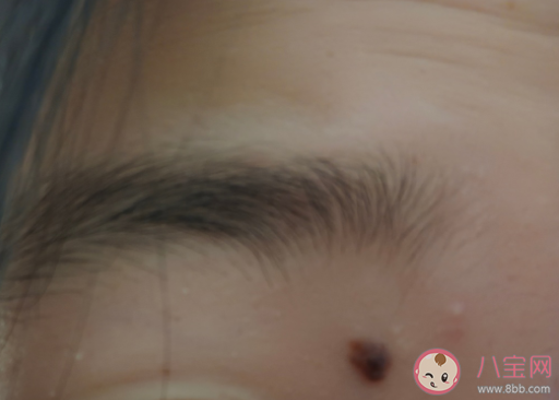 如何區分痣和黑色素瘤 長在什么部位的痣要多當心 如何區分痣和黑色素瘤 長在什么部位的痣要多當心