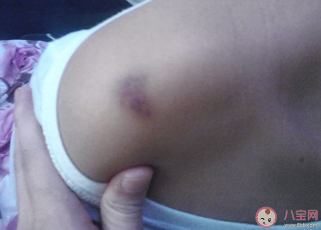 什么樣的淤青需重視 哪些淤青要警惕 什么樣的淤青需重視 哪些淤青要警惕