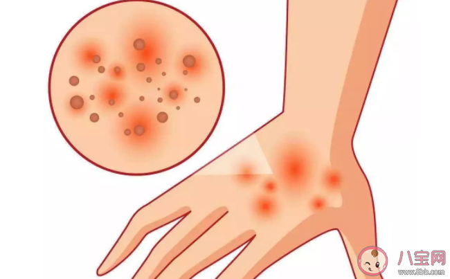 神經性皮炎和什么有關 神經性皮炎有傳染性嗎 神經性皮炎和什么有關 神經性皮炎有傳染性嗎