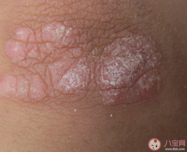 神經性皮炎和什么有關 神經性皮炎有傳染性嗎 神經性皮炎和什么有關 神經性皮炎有傳染性嗎