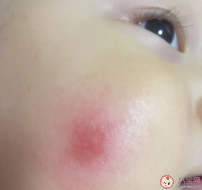 蚊蟲叮咬對身體有什么危害 蚊子喜歡咬什么人 蚊蟲叮咬對身體有什么危害 蚊子喜歡咬什么人