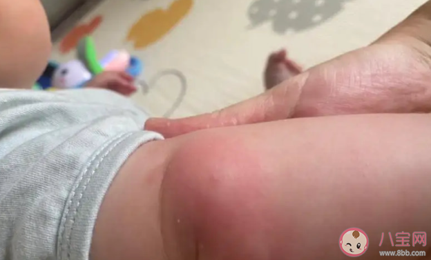 蚊蟲叮咬對身體有什么危害 蚊子喜歡咬什么人 蚊蟲叮咬對身體有什么危害 蚊子喜歡咬什么人