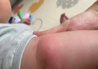 蚊蟲叮咬對身體有什么危害 蚊子喜歡咬什么人