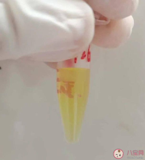 牛奶血是什么意思 牛奶血為什么不能給病人輸用