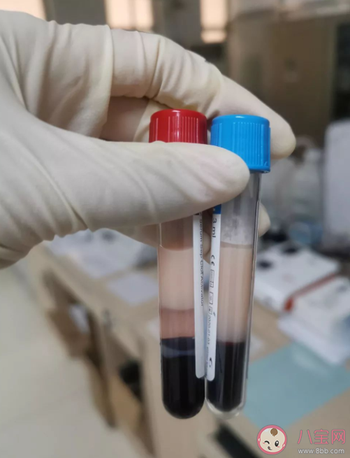 哪些人容易產(chǎn)生乳糜血 怎樣預(yù)防乳糜血 哪些人容易產(chǎn)生乳糜血 怎樣預(yù)防乳糜血