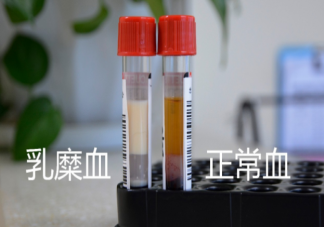 哪些人容易產(chǎn)生乳糜血 怎樣預防乳糜血