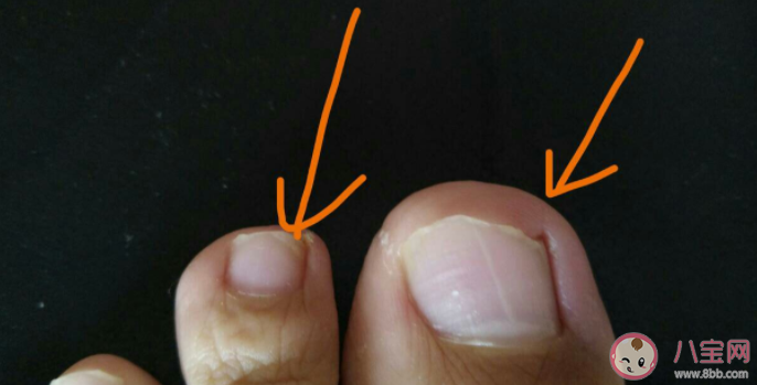 甲溝炎感染的不同階段表現 如何防治甲溝炎