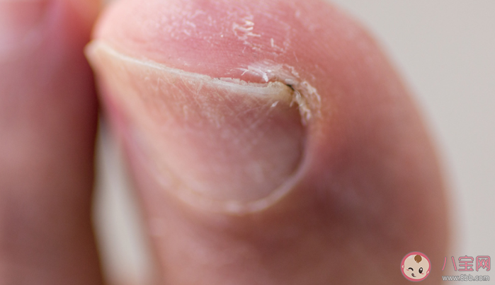 甲溝炎感染的不同階段表現 如何防治甲溝炎