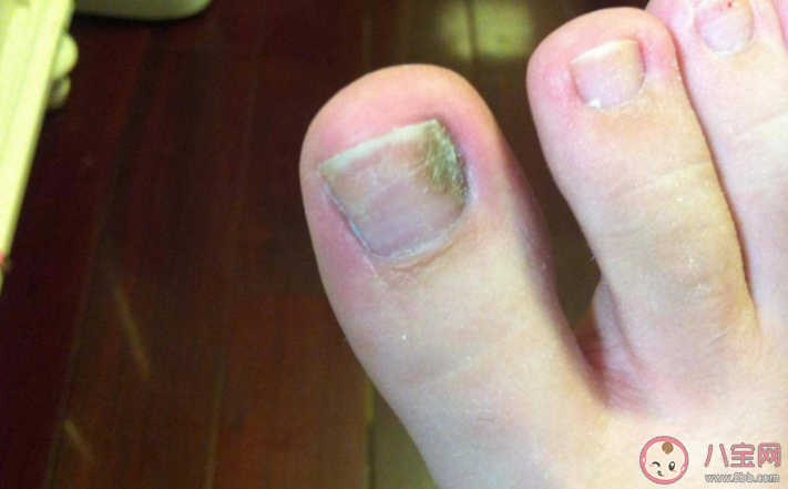 甲溝炎感染的不同階段表現 如何防治甲溝炎