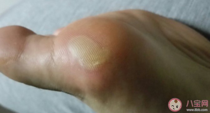 腳上磨起了泡要不要挑破 為什么腳容易磨出水泡 腳上磨起了泡要不要挑破 為什么腳容易磨出水泡