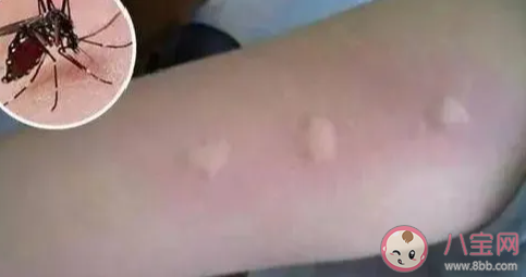 蚊子包是怎樣產(chǎn)生的 被蚊子咬了怎么止癢 蚊子包是怎樣產(chǎn)生的 被蚊子咬了怎么止癢