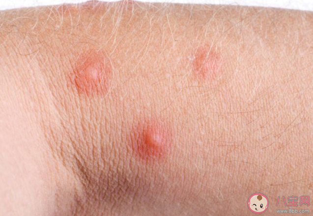 尖銳濕疣一定是通過性傳播的嗎 兒童感染尖銳濕疣的原因有哪些 尖銳濕疣一定是通過性傳播的嗎 兒童感染尖銳濕疣的原因有哪些