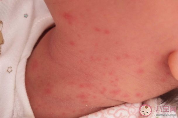 桃子水是祛痱神器嗎 寶寶防痱指南 桃子水是祛痱神器嗎 寶寶防痱指南