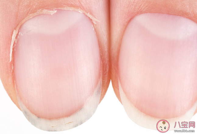 幾個(gè)月牙最健康 手指月牙突然多或少是身體有問題嗎 幾個(gè)月牙最健康 手指月牙突然多或少是身體有問題嗎