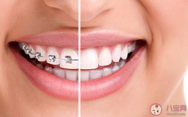 牙齒矯正必須要拔牙嗎 牙齒矯正可以不對稱拔牙嗎 牙齒矯正必須要拔牙嗎 牙齒矯正可以不對稱拔牙嗎