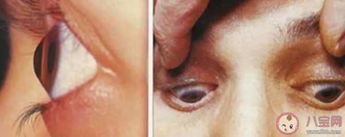 經常揉眼可能導致眼球變形 經常揉眼還有哪些危害 經常揉眼可能導致眼球變形 經常揉眼還有哪些危害