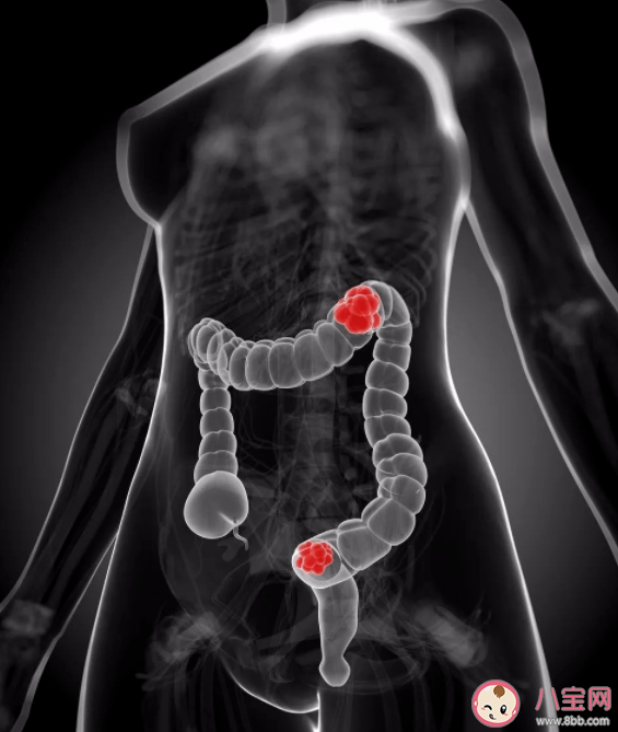 怎么判斷自身患癌風(fēng)險(xiǎn)高不高 有家族史如何防癌 怎么判斷自身患癌風(fēng)險(xiǎn)高不高 有家族史如何防癌