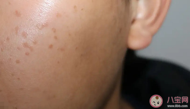 扁平疣是性病嗎 扁平疣有什么典型特征 扁平疣是性病嗎 扁平疣有什么典型特征