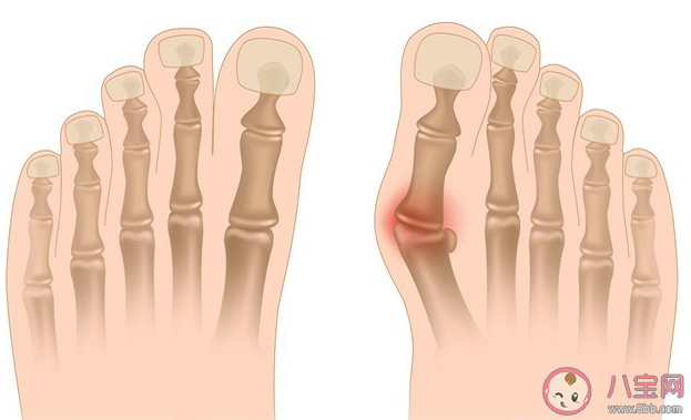如何判斷自己是否有拇外翻 拇趾外翻穿矯正器有用嗎 如何判斷自己是否有拇外翻 拇趾外翻穿矯正器有用嗎